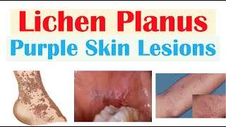 Lichen Planus “Purple Skin Lesions”  Causes Signs amp Symptoms Diagnosis Treatment [upl. by Eloken]