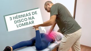 ELA TEM TRÊS HÉRNIAS DE DISCO UMA INFLAMAÇÃO E NÃO CONSEGUE APOIAR A LOMBAR AO DEITAR [upl. by Martres286]