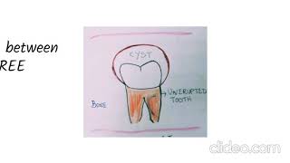 Dentigerous Cyst  Pathogenesis [upl. by Trinetta]