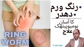 RINGWORM TREATMENT WITH HOMOEOPATHIC MEDICINESरिंग वर्म ट्रीटमेंटURDUHINDI DR AZHAR IQBAL [upl. by Caitlin]