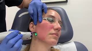 VBeam Perfecta pulse dye laser treatment for facial redness and rosacea by Dr Shaun Patel [upl. by Andy]