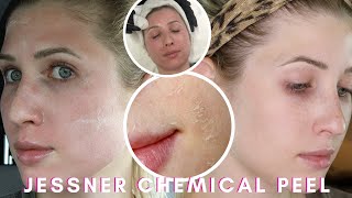 My CHEMICAL PEEL Experience  JESSNER Chemical PEEL [upl. by Melinda]