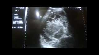 ultrasound of a RETROPERITONEAL MASS part 1a [upl. by Elleinnad]