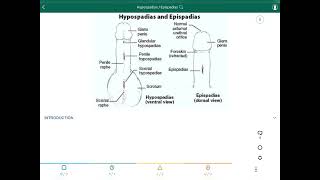 Hypospadias  Epispadias  فتحة الأحليل السفلية  فتحة الأحليل العلوية [upl. by Yntruoc142]