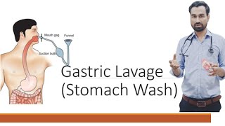 GASTRIC LAVAGE STOMACH WASH STOMACH IRRIGATION ICU PROCEDURE DR SALMAN NASIR [upl. by Akemor]