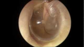 Serous Otitis Media [upl. by Aleris33]