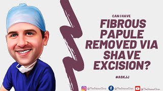 Can I have a fibrous papule removed via shave excision [upl. by Mayram]