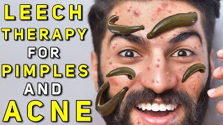 Leech Therapy for Skin Problems like Acne Pimples [upl. by Boles]