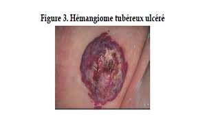 DERMATOLOGIE  cours 4  Angiome du nourrisson [upl. by Dix]