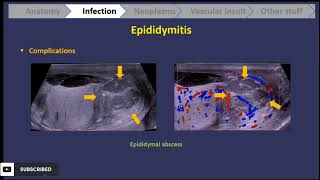 scrotal ultrasound  everything u should know  part 1 [upl. by Alyk]