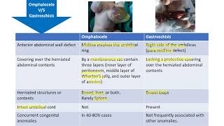 Omphalocele vs Gastroschisis  Spot Diagnosis  6  Pediatrics [upl. by Trabue]