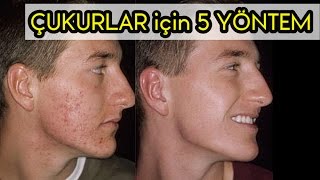 Sivilce İzleri  Çukurları  Geçirmenin 5 Yolu  │ Aras Barlas [upl. by Neirual]