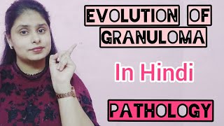 EVOLUTION OF GRANULOMA  FORMATION OF GRANULOMA  PATHOLOGY IN HINDI [upl. by Eichman]