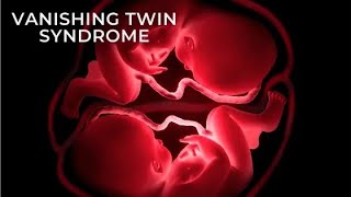 Vanishing twin syndrome  Fetus papyraceus  Death and disappearance of one member of a twin [upl. by Eniamor]