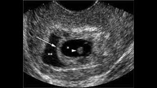 Haematoma surrounding gestational sac amp its significance [upl. by Ainolopa]