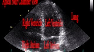 Echocardiogram Inspiratory Lung Interference Examples [upl. by Ientruoc797]