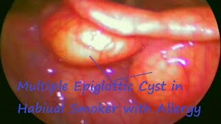 Laryngology  Multiple Epiglottic Cyst in Habiual Smoker with Allergy [upl. by Florette274]