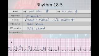 Basic Electrophysiology part 7  Atrial Rhyhtms part 2 WAP MAT EAT SVT [upl. by Dazhahs630]