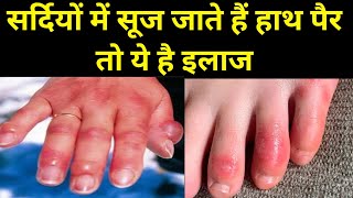 सर्दियों में हाथ पैर सूजन Home Remedy for RednessSwelling Fingers sardi me hath par sujan ka ilaj [upl. by Enitsej459]