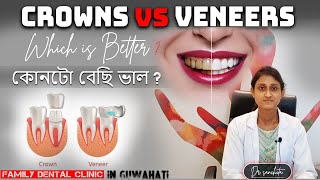 CROWNS VS VENEERS  Which is best  Dr Sanchita Kalita [upl. by Siclari360]