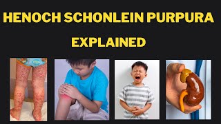 Henoch Schonlein Purpura IgA vasculitis Pathophysiology presentations investigations and treatment [upl. by Audwen]