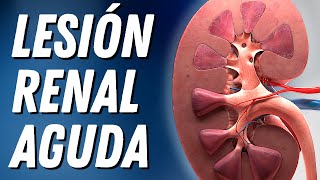 Lesión Renal Aguda Explicada Claramente [upl. by Alimac]