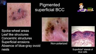 Dermoscopy features associated with subtypes of basal cell carcinomas  Dr Harold S Rabinovitz [upl. by Troyes]