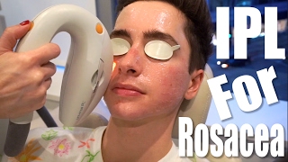 Rosacea Treatment with IPL Laser ft Eric Smith [upl. by Kola]