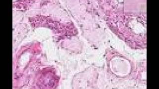 Histopathology Testis Atrophy [upl. by Saphra583]