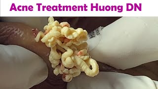 Acne Treatment Huong Da Nang  2024 Acne Huong 715 [upl. by Elleuqar]