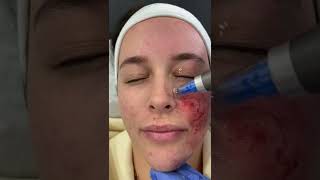 Microneedling with Dermapen 4 at DRMEDISPA [upl. by Esinej60]