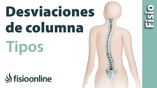 ¿Tipos de desviaciones de la columna [upl. by Fai]