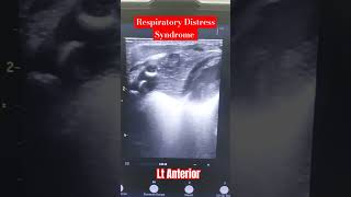 Neonatal Lung Ultrasound Preterm with Respiratory distress Syndrome neonates lungultrasoundpocus [upl. by Aifos]