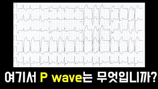 이것이 P wave 라는 확신을 갖는 방법 김교수의 실전 심전도 11강  외우지 않고 이해하는 Sgarbossa criteria [upl. by Snell]