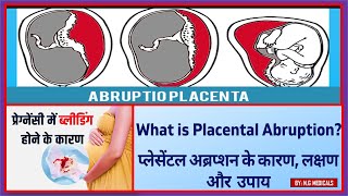 placenta abruptio part1  full explanation in Hindi by NG MEDICALS [upl. by Acireed]