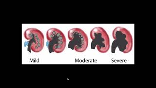 Hydronephrosis  Ultrasound [upl. by Ilrebma]