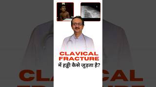 Clavical Fracture  Clavical Fracture में हड्डी कैसी जुड़ती है ।  Collar Bone Fracture in Children [upl. by Heim847]