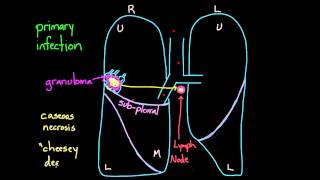 Primary and Secondary TB [upl. by Oshinski]