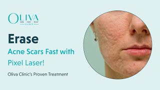 Erase Acne Scars Fast with Pixel Laser  Oliva Clinic’s Proven Treatment [upl. by Amsirak]