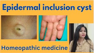 Epidermal inclusion cyst treatment  Sebaceous cyst symptomscauses amp homeopathic medicine in hindi [upl. by Glori]