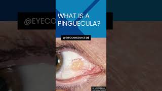 what is a pinguecula ¦eyecognizance [upl. by Older]