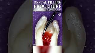 Dental Filling Procedure Cavity Filling dental dentist cavityfilling medical medicine shorts [upl. by Convery]