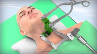 CS1600L Cervical Retractor Animation [upl. by Enayr]