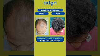 2 Years  2500 Grafts Hair Transplant Result Hair fall  Hair loss  Hair Growth  Hair Regrowth [upl. by Waldos182]