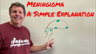 Meningioma A Simple Explanation [upl. by Yrotciv]