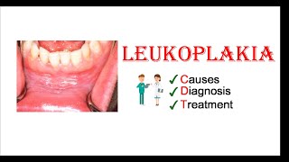 Leukoplakia  Causes Diagnosis amp Treatment [upl. by Fleur]