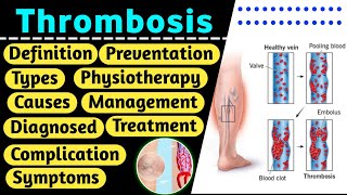 Thrombosis  Thrombosis in hindi  DVT  Thrombosis definition  thrombosis pathology [upl. by Boggs126]