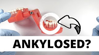 How To Extract Ankylosed Teeth  OnlineExodontiacom [upl. by Leonteen]