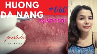 060 pustules around the lips and face  Hương Đà Nẵng [upl. by Katheryn]