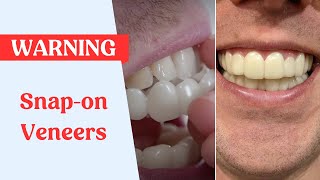 Snap On Veneers Warning [upl. by Haramat340]